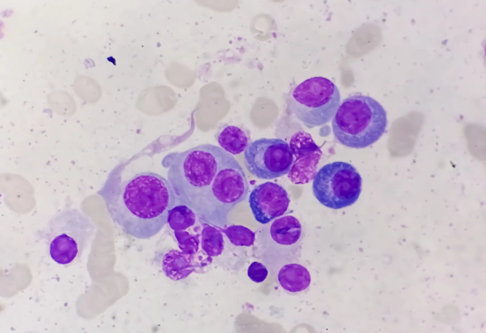 Imagen de microscopio con células afectadas por mieloma múltiple